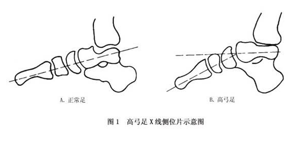 足底壓力分析儀